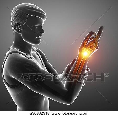 Stock Photo - Man with wrist pain, computer illustration.. Fotosearch