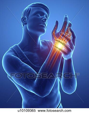 Man with wrist pain, computer illustration. View Large Photo Image Stock Photography - Man with wrist pain, computer illustration.. Fotosearch