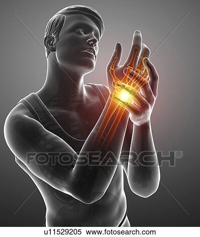 Man with wrist pain, computer illustration. View Large Photo Image Stock Photography - Man with wrist pain, computer illustration.. Fotosearch