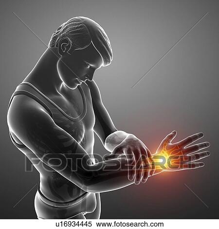 Stock Photography - Man with wrist pain, computer illustration.. Fotosearch