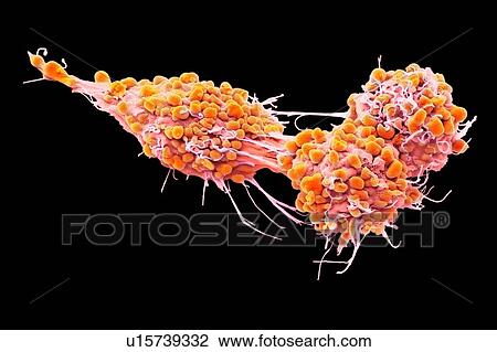 Stock Image - Ovarian cancer cells. Coloured scanning electron micrograph (SEM) of ovarian cancer cells. Cancer cells are typically large, have an irregular surface and divide rapidly in a chaotic manner. Clumps (tumours) of these cells may form and can invade and.... Fotosearch