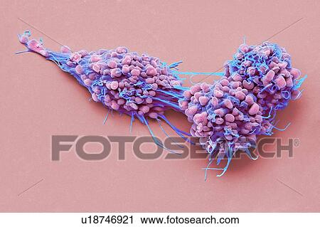Stock Image - Ovarian cancer cells. Coloured scanning electron micrograph (SEM) of ovarian cancer cells. Cancer cells are typically large, have an irregular surface and divide rapidly in a chaotic manner. Clumps (tumours) of these cells may form and can invade and.... Fotosearch