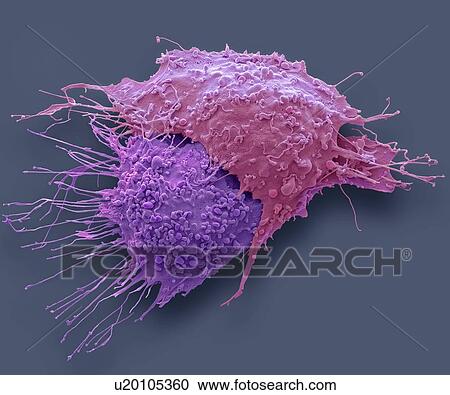 Ovarian cancer cells. Coloured scanning electron micrograph (SEM) of ovarian cancer cells. Cancer cells are typically large, have an irregular surface and divide rapidly in a chaotic manner. Clumps (tumours) of these cells may form and can invade and... View Large Photo Image Stock Image - Ovarian cancer cells. Coloured scanning electron micrograph (SEM) of ovarian cancer cells. Cancer cells are typically large, have an irregular surface and divide rapidly in a chaotic manner. Clumps (tumours) of these cells may form and can invade and.... Fotosearch