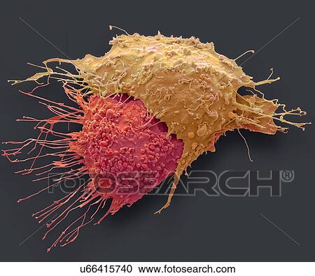 Stock Image - Ovarian cancer cells. Coloured scanning electron micrograph (SEM) of ovarian cancer cells. Cancer cells are typically large, have an irregular surface and divide rapidly in a chaotic manner. Clumps (tumours) of these cells may form and can invade and.... Fotosearch