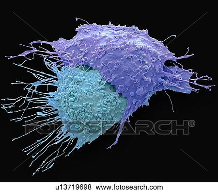 Ovarian cancer cells. Coloured scanning electron micrograph (SEM) of ovarian cancer cells. Cancer cells are typically large, have an irregular surface and divide rapidly in a chaotic manner. Clumps (tumours) of these cells may form and can invade and... View Large Photo Image Stock Photo - Ovarian cancer cells. Coloured scanning electron micrograph (SEM) of ovarian cancer cells. Cancer cells are typically large, have an irregular surface and divide rapidly in a chaotic manner. Clumps (tumours) of these cells may form and can invade and.... Fotosearch