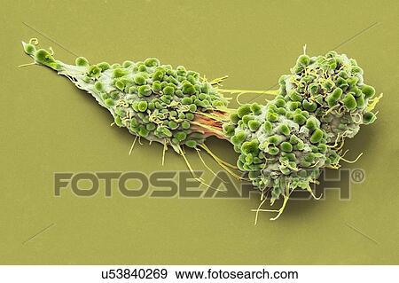 Stock Photo - Ovarian cancer cells. Coloured scanning electron micrograph (SEM) of ovarian cancer cells. Cancer cells are typically large, have an irregular surface and divide rapidly in a chaotic manner. Clumps (tumours) of these cells may form and can invade and.... Fotosearch