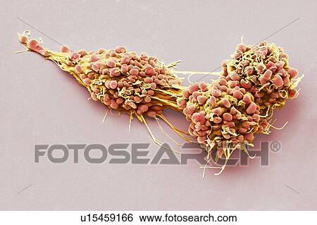 Ovarian cancer cells. Coloured scanning electron micrograph (SEM) of ovarian cancer cells. Cancer cells are typically large, have an irregular surface and divide rapidly in a chaotic manner. Clumps (tumours) of these cells may form and can invade and... View Large Photo Image Stock Photograph - Ovarian cancer cells. Coloured scanning electron micrograph (SEM) of ovarian cancer cells. Cancer cells are typically large, have an irregular surface and divide rapidly in a chaotic manner. Clumps (tumours) of these cells may form and can invade and.... Fotosearch