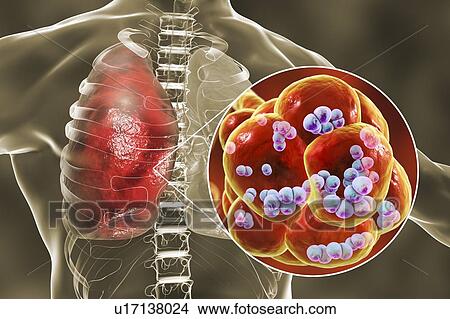 Picture - Pneumococcal pneumonia. Computer illustration of Streptococcus pneumoniae (pneumococci) bacteria inside the alveoli of the lungs, causing pneumonia.. Fotosearch