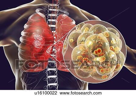 Stock Image - Pneumococcal pneumonia. Computer illustration of Streptococcus pneumoniae (pneumococci) bacteria inside the alveoli of the lungs, causing pneumonia.. Fotosearch