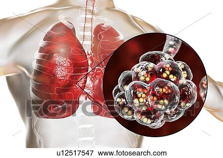Pneumococcal pneumonia. Computer illustration of Streptococcus pneumoniae (pneumococci) bacteria inside the alveoli of the lungs, causing pneumonia. View Large Photo Image Stock Photo - Pneumococcal pneumonia. Computer illustration of Streptococcus pneumoniae (pneumococci) bacteria inside the alveoli of the lungs, causing pneumonia.. Fotosearch