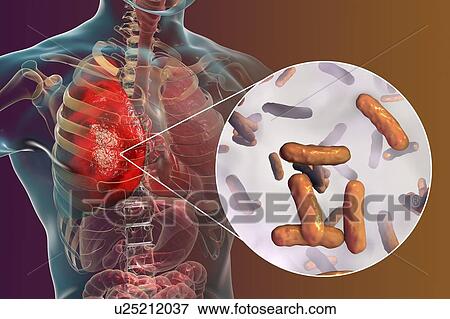 Stock Photo - Pneumonia caused by bacteria Pseudomonas aeruginosa, computer illustration. P. aeruginosa is a Gram-negative bacterium which causes multiple antibiotic resistant nosocomial (hospital-acquired) infections of different location, including pneumonia,.... Fotosearch