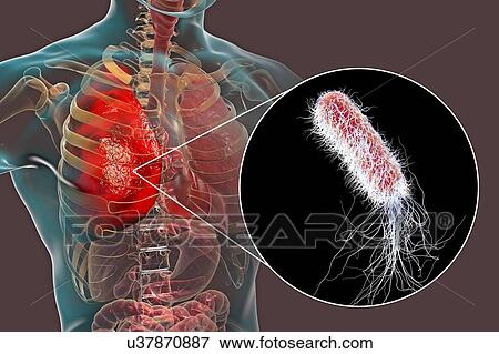 Pneumonia caused by bacteria Pseudomonas aeruginosa, computer illustration. P. aeruginosa is a Gram-negative bacterium which causes multiple antibiotic resistant nosocomial (hospital-acquired) infections of different location, including pneumonia,... View Large Photo Image Stock Photo - Pneumonia caused by bacteria Pseudomonas aeruginosa, computer illustration. P. aeruginosa is a Gram-negative bacterium which causes multiple antibiotic resistant nosocomial (hospital-acquired) infections of different location, including pneumonia,.... Fotosearch