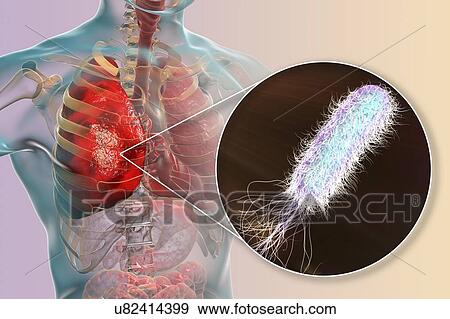 Stock Photo - Pneumonia caused by bacteria Pseudomonas aeruginosa, computer illustration. P. aeruginosa is a Gram-negative bacterium which causes multiple antibiotic resistant nosocomial (hospital-acquired) infections of different location, including pneumonia,.... Fotosearch