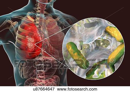 Stock Photo - Pneumonia caused by bacteria Pseudomonas aeruginosa, computer illustration. P. aeruginosa is a Gram-negative bacterium which causes multiple antibiotic resistant nosocomial (hospital-acquired) infections of different location, including pneumonia,.... Fotosearch