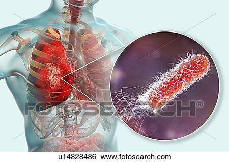 Stock Photograph - Pneumonia caused by bacteria Pseudomonas aeruginosa, computer illustration. P. aeruginosa is a Gram-negative bacterium which causes multiple antibiotic resistant nosocomial (hospital-acquired) infections of different location, including pneumonia,.... Fotosearch