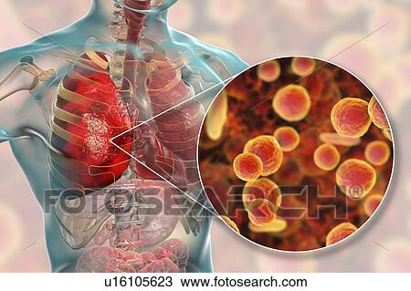 Stock Image - Pneumonia caused by Mycoplasma pneumoniae bacteria, conceptual computer illustration. Mycoplasmas are the smallest cellular organisms known (diameter 0. 3-0. 9 microns). They resemble bacteria in some respects (some authorities regard them as primitive.... Fotosearch