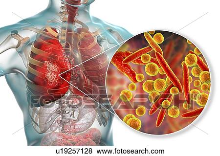 Stock Photo - Pneumonia caused by Mycoplasma pneumoniae bacteria, conceptual computer illustration. Mycoplasmas are the smallest cellular organisms known (diameter 0. 3-0. 9 microns). They resemble bacteria in some respects (some authorities regard them as primitive.... Fotosearch