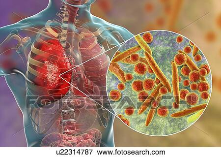 Stock Photo - Pneumonia caused by Mycoplasma pneumoniae bacteria, conceptual computer illustration. Mycoplasmas are the smallest cellular organisms known (diameter 0. 3-0. 9 microns). They resemble bacteria in some respects (some authorities regard them as primitive.... Fotosearch