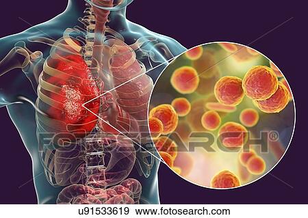 Stock Photo - Pneumonia caused by Mycoplasma pneumoniae bacteria, conceptual computer illustration. Mycoplasmas are the smallest cellular organisms known (diameter 0. 3-0. 9 microns). They resemble bacteria in some respects (some authorities regard them as primitive.... Fotosearch