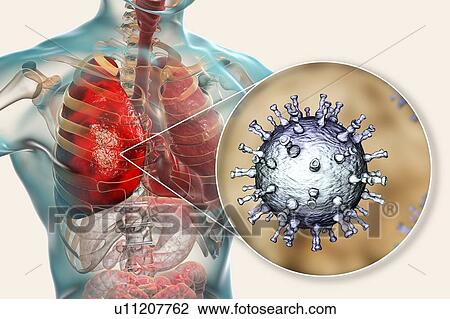Stock Image - Pneumonia caused by varicella zoster virus (VZV), computer illustration. VZV is a virus from the Herpesviridae family, the causative agent of chickenpox and shingles. In severe cases VZV may cause complications, such as pneumonia and encephalitis.. Fotosearch