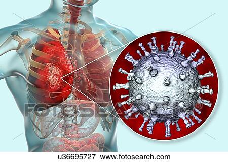 Pneumonia caused by varicella zoster virus (VZV), computer illustration. VZV is a virus from the Herpesviridae family, the causative agent of chickenpox and shingles. In severe cases VZV may cause complications, such as pneumonia and encephalitis. View Large Photo Image Stock Photo - Pneumonia caused by varicella zoster virus (VZV), computer illustration. VZV is a virus from the Herpesviridae family, the causative agent of chickenpox and shingles. In severe cases VZV may cause complications, such as pneumonia and encephalitis.. Fotosearch