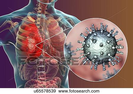 Stock Photo - Pneumonia caused by varicella zoster virus (VZV), computer illustration. VZV is a virus from the Herpesviridae family, the causative agent of chickenpox and shingles. In severe cases VZV may cause complications, such as pneumonia and encephalitis.. Fotosearch