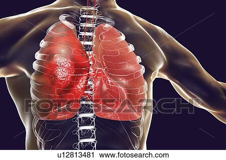 Stock Image - Pneumonia, illustration. Pneumonia is an inflammatory condition of the lung.. Fotosearch