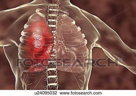 Stock Image - Pneumonia, illustration. Pneumonia is an inflammatory condition of the lung.. Fotosearch