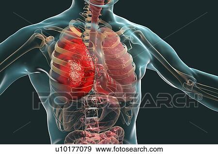 Stock Photo - Pneumonia, illustration. Pneumonia is an inflammatory condition of the lung.. Fotosearch