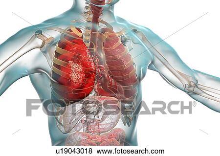 Stock Photo - Pneumonia, illustration. Pneumonia is an inflammatory condition of the lung.. Fotosearch