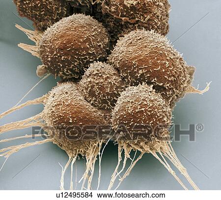 Prostate cancer cells, Coloured scanning electron micrograph (SEM). Such cells can clump to form tumours, which often invade and destroy surrounding tissues. The prostate is a small gland found in men just below the bladder, surrounding the urethra,... View Large Photo Image Picture - Prostate cancer cells, Coloured scanning electron micrograph (SEM). Such cells can clump to form tumours, which often invade and destroy surrounding tissues. The prostate is a small gland found in men just below the bladder, surrounding the urethra,.... Fotosearch