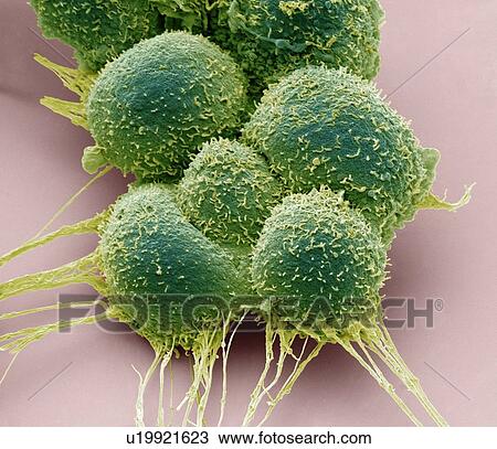 Prostate cancer cells, Coloured scanning electron micrograph (SEM). Such cells can clump to form tumours, which often invade and destroy surrounding tissues. The prostate is a small gland found in men just below the bladder, surrounding the urethra,... View Large Photo Image Stock Image - Prostate cancer cells, Coloured scanning electron micrograph (SEM). Such cells can clump to form tumours, which often invade and destroy surrounding tissues. The prostate is a small gland found in men just below the bladder, surrounding the urethra,.... Fotosearch