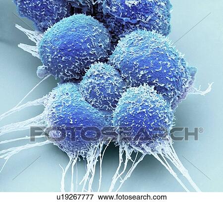 Prostate cancer cells, Coloured scanning electron micrograph (SEM). Such cells can clump to form tumours, which often invade and destroy surrounding tissues. The prostate is a small gland found in men just below the bladder, surrounding the urethra,... View Large Photo Image Stock Photo - Prostate cancer cells, Coloured scanning electron micrograph (SEM). Such cells can clump to form tumours, which often invade and destroy surrounding tissues. The prostate is a small gland found in men just below the bladder, surrounding the urethra,.... Fotosearch