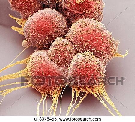 Stock Photography - Prostate cancer cells, Coloured scanning electron micrograph (SEM). Such cells can clump to form tumours, which often invade and destroy surrounding tissues. The prostate is a small gland found in men just below the bladder, surrounding the urethra,.... Fotosearch