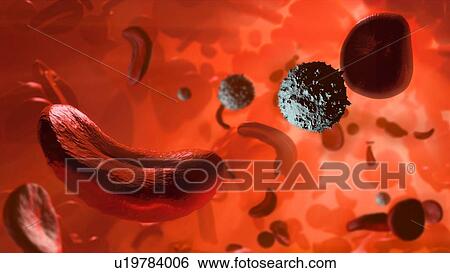 Sickle cell anaemia. Illustration showing white blood cells (round, white), normal red blood cells (round), and red blood cells affected by sickle cell anaemia (crescent shaped). This is a disease in which the red blood cells contain an abnormal form... View Large Photo Image Stock Photograph - Sickle cell anaemia. Illustration showing white blood cells (round, white), normal red blood cells (round), and red blood cells affected by sickle cell anaemia (crescent shaped). This is a disease in which the red blood cells contain an abnormal form.... Fotosearch