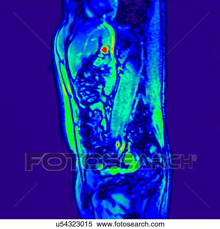 Side view abdomen I scan of 60 year old male patient with kidney stone View Large Photo Image Stock Photography - Side view abdomen I scan of 60 year old male patient with kidney stone. Fotosearch