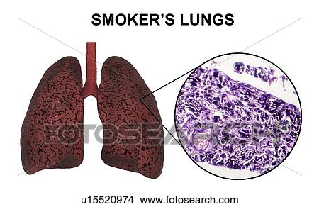 Picture - Smoker's lungs, computer illustration and light micrograph.. Fotosearch