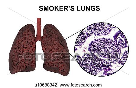 Stock Image - Smoker's lungs, computer illustration and light micrograph.. Fotosearch