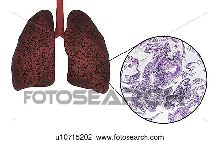 Stock Image - Smoker's lungs, computer illustration and light micrograph.. Fotosearch