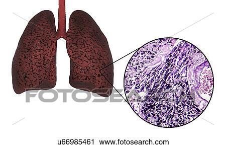 Stock Image - Smoker's lungs, computer illustration and light micrograph.. Fotosearch