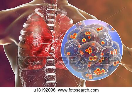 Stock Photograph - Staphylococcal pneumonia. Computer illustration of Staphylococcus aureus bacteria inside the alveoli of the lungs, causing pneumonia.. Fotosearch