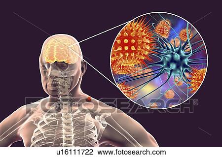 Tick-bourne encephalitis, computer illustration. Tick- borne encephalitis (inflammation of the brain) covers a range of illnesses ranging from a severe paralytic encephalitis, which occurs in Siberia and is transmitted by Ixodes persulcatus, to a less... View Large Photo Image Stock Image - Tick-bourne encephalitis, computer illustration. Tick- borne encephalitis (inflammation of the brain) covers a range of illnesses ranging from a severe paralytic encephalitis, which occurs in Siberia and is transmitted by Ixodes persulcatus, to a less.... Fotosearch