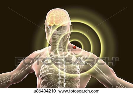 Stock Image - Tick-bourne encephalitis, computer illustration. Tick- borne encephalitis (inflammation of the brain) covers a range of illnesses ranging from a severe paralytic encephalitis, which occurs in Siberia and is transmitted by Ixodes persulcatus, to a less.... Fotosearch