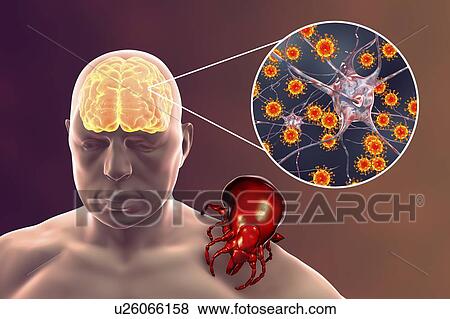 Stock Photo - Tick-bourne encephalitis, computer illustration. Tick- borne encephalitis (inflammation of the brain) covers a range of illnesses ranging from a severe paralytic encephalitis, which occurs in Siberia and is transmitted by Ixodes persulcatus, to a less.... Fotosearch