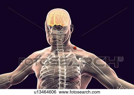Tick-bourne encephalitis, computer illustration. Tick- borne encephalitis (inflammation of the brain) covers a range of illnesses ranging from a severe paralytic encephalitis, which occurs in Siberia and is transmitted by Ixodes persulcatus, to a less... View Large Photo Image Stock Photograph - Tick-bourne encephalitis, computer illustration. Tick- borne encephalitis (inflammation of the brain) covers a range of illnesses ranging from a severe paralytic encephalitis, which occurs in Siberia and is transmitted by Ixodes persulcatus, to a less.... Fotosearch