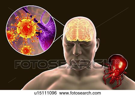 Stock Photograph - Tick-bourne encephalitis, computer illustration. Tick- borne encephalitis (inflammation of the brain) covers a range of illnesses ranging from a severe paralytic encephalitis, which occurs in Siberia and is transmitted by Ixodes persulcatus, to a less.... Fotosearch
