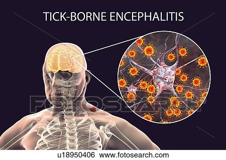 Tick-bourne encephalitis, computer illustration. Tick- borne encephalitis (inflammation of the brain) covers a range of illnesses ranging from a severe paralytic encephalitis, which occurs in Siberia and is transmitted by Ixodes persulcatus, to a less... View Large Photo Image Stock Photograph - Tick-bourne encephalitis, computer illustration. Tick- borne encephalitis (inflammation of the brain) covers a range of illnesses ranging from a severe paralytic encephalitis, which occurs in Siberia and is transmitted by Ixodes persulcatus, to a less.... Fotosearch