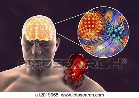 Tick-bourne encephalitis, computer illustration. Tick- borne encephalitis (inflammation of the brain) covers a range of illnesses ranging from a severe paralytic encephalitis, which occurs in Siberia and is transmitted by Ixodes persulcatus, to a less... View Large Photo Image Stock Photography - Tick-bourne encephalitis, computer illustration. Tick- borne encephalitis (inflammation of the brain) covers a range of illnesses ranging from a severe paralytic encephalitis, which occurs in Siberia and is transmitted by Ixodes persulcatus, to a less.... Fotosearch