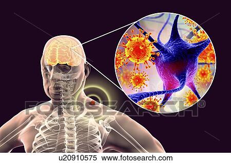 Tick-bourne encephalitis, computer illustration. Tick- borne encephalitis (inflammation of the brain) covers a range of illnesses ranging from a severe paralytic encephalitis, which occurs in Siberia and is transmitted by Ixodes persulcatus, to a less... View Large Photo Image Stock Photography - Tick-bourne encephalitis, computer illustration. Tick- borne encephalitis (inflammation of the brain) covers a range of illnesses ranging from a severe paralytic encephalitis, which occurs in Siberia and is transmitted by Ixodes persulcatus, to a less.... Fotosearch