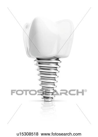 Stock Photo - Tooth implant, illustration.. Fotosearch
